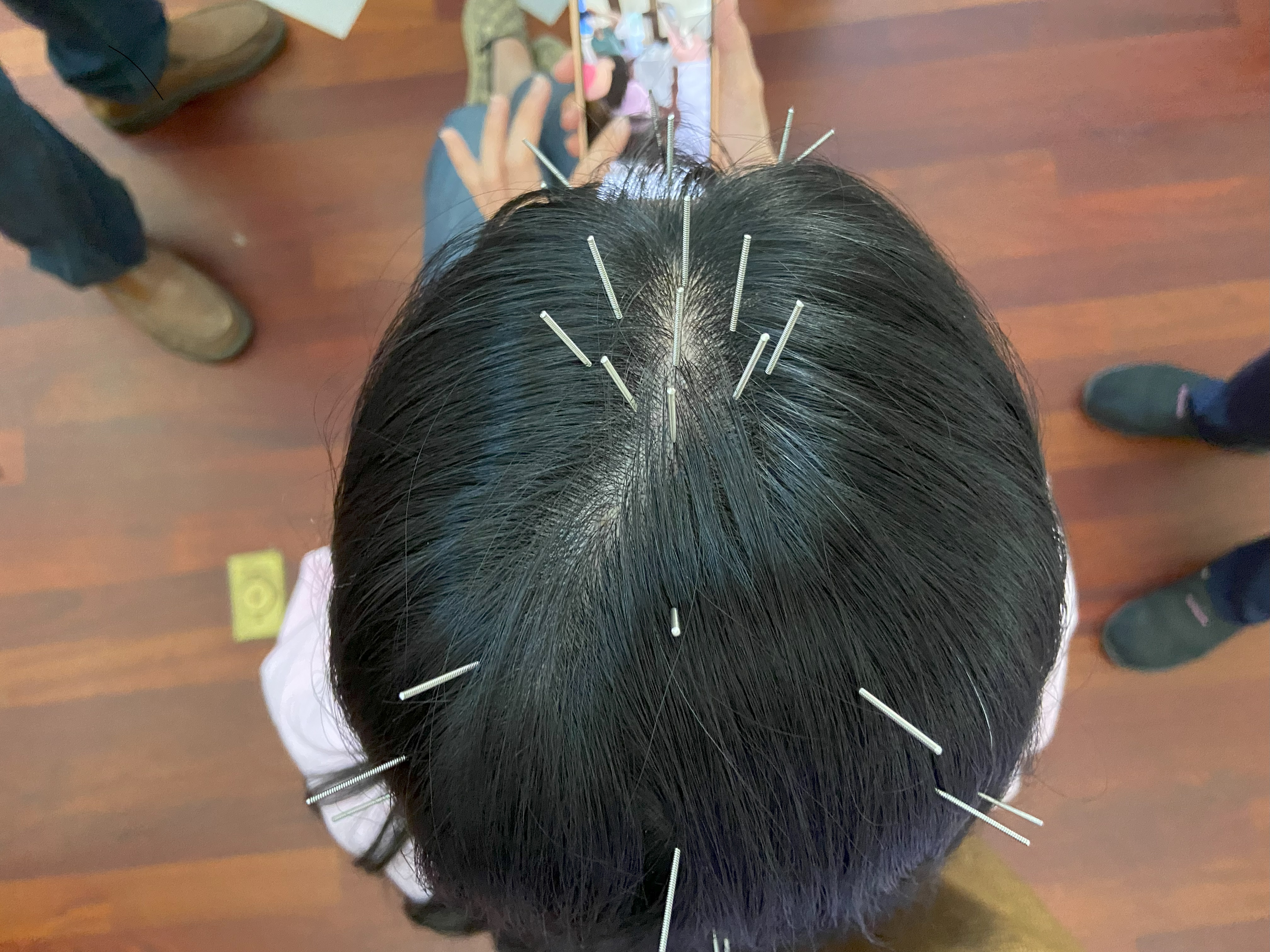 Acupuncture Treatment at Allcare Acupuncture