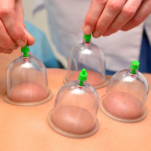 Cupping Therapy at Allcare Acupuncture